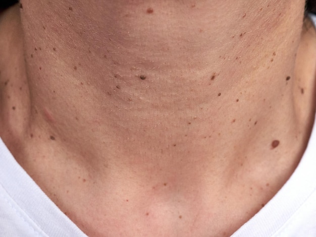 Neck of a woman with many small moles and warts