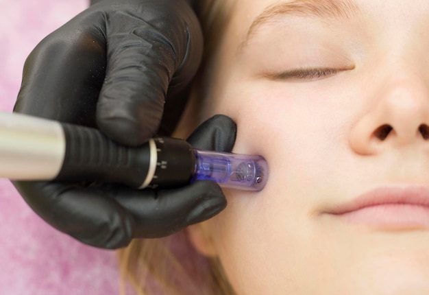 Needle mesotherapy. Cosmetologist performs needle mesotherapy on a womans face. Beautiful woman receiving microneedling rejuvenation treatment. Needle lifting