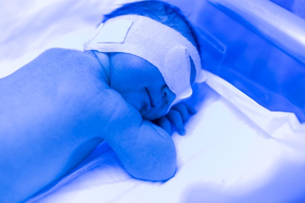 A newborn baby lies under ultraviolet lamps under blue light High bilirubin treatment of childhood jaundice ultraviolet incubator