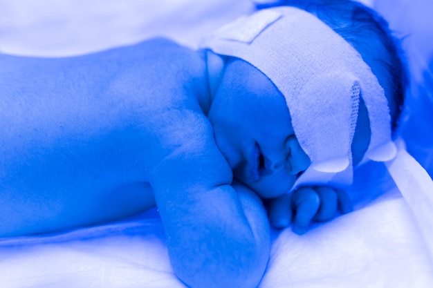 A newborn baby lies under ultraviolet lamps under blue light High bilirubin treatment of childhood jaundice ultraviolet incubator