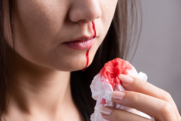 Nosebleed , woman with a bloody nose, healthcare concept.