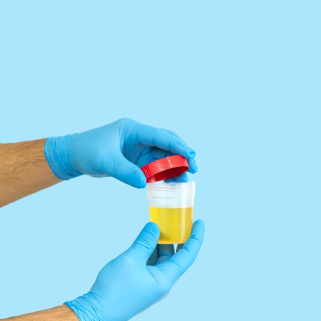 Nurse or medical worker opening urine sample container for medical urinalysis