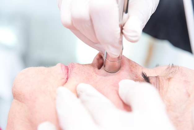 Older adult woman in a spa performing diamond tip treatment removing blackheads