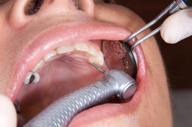 Photo oral rehabilitation process partial removable prosthesis