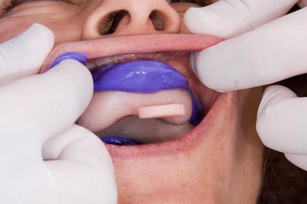 Photo oral rehabilitation process partial removable prosthesis