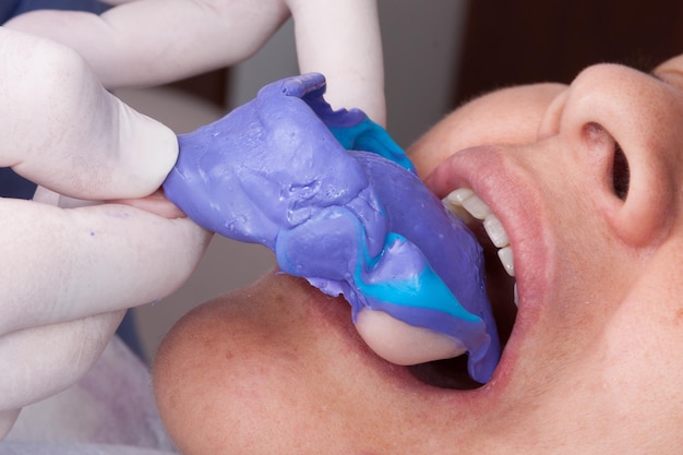 Photo oral rehabilitation process partial removable prosthesis