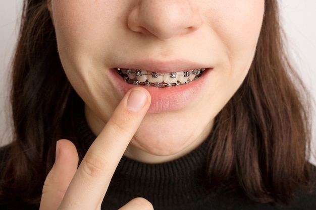 Orthodontic treatment. Dental care concept. Smiling teenage girl with braces. Metal braces close-up on the teeth. High quality photo