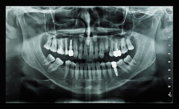 Orthopantomograph panoramic image radiograph of teeth