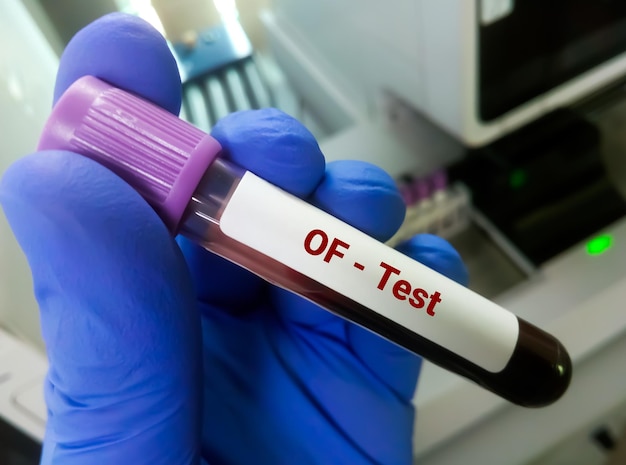 Osmotic Fragility or OF a screening test for thalassemia