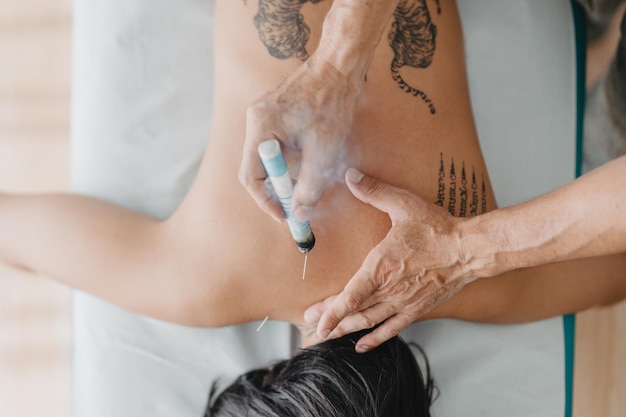 Overhead shot of an acupuncturist heating the acupuncture zones with moxa