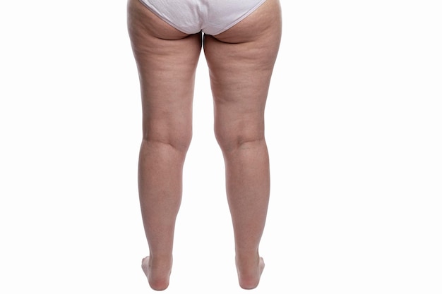 Overweight woman in panties with cellulite and varicose veins on her legs Obesity and disease Isolated on white background Back view