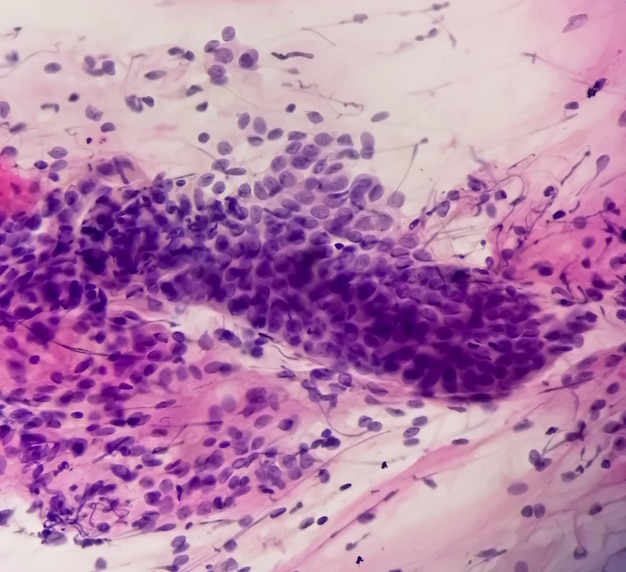 PAPS Smear study of a young women under microscopy showing Atrophic changes in uterus