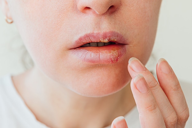 Part of young woman face with finger touching pain on lips with herpes affected beauty dermatology concept