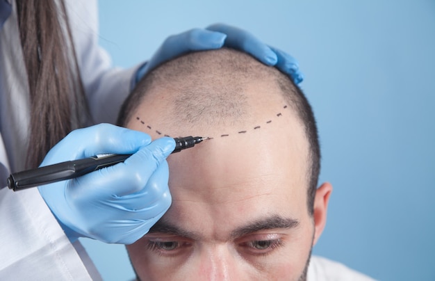 Patient suffering from hair loss in consultation with a doctor. Doctor using skin marker