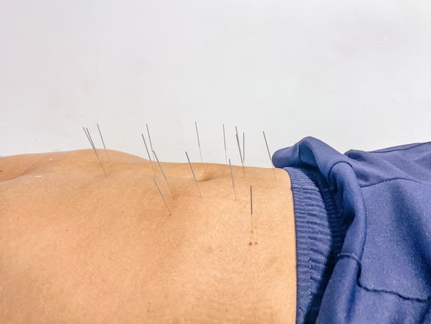 Patients undergoing acupuncture on the body in the hostipal and clinic