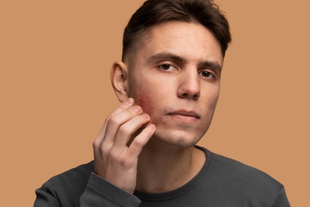 Person dealing with rosacea