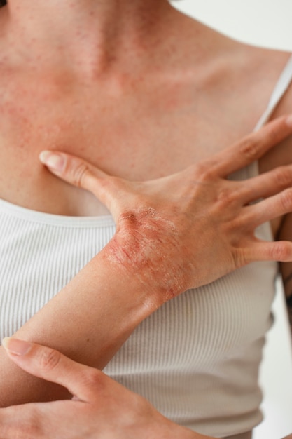 Photo person suffering from dermatitis skin condition