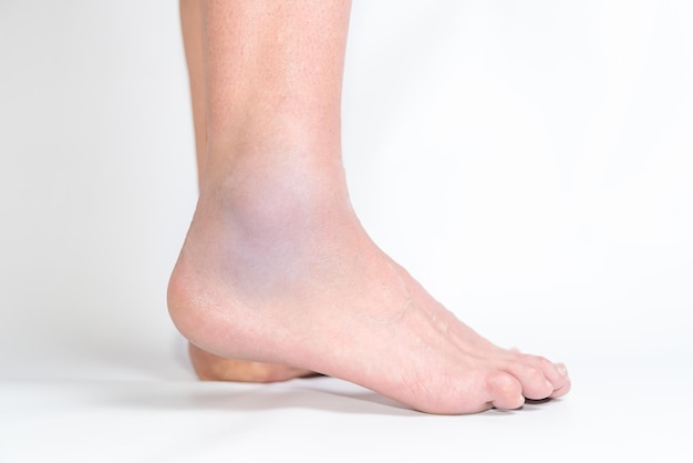 a person with a sprained foot dislocated ankle bruise walker boot