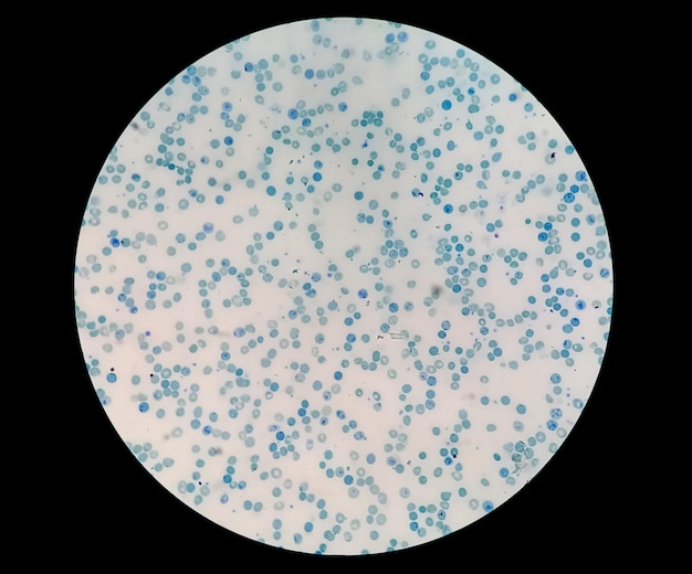 Photomicrograph of abnormal reticulocyte count with methylene blue staining