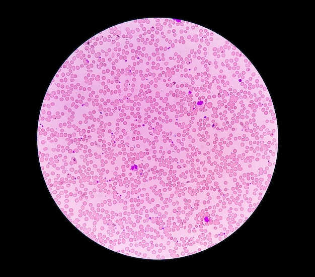 Photomicrograph of Hemoglobin D trait or hemoglobin D Punjab with iron deficiency anemia