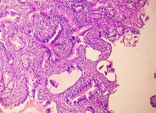 Photomicrograph showing adenocarcinoma a concept of cancer awareness