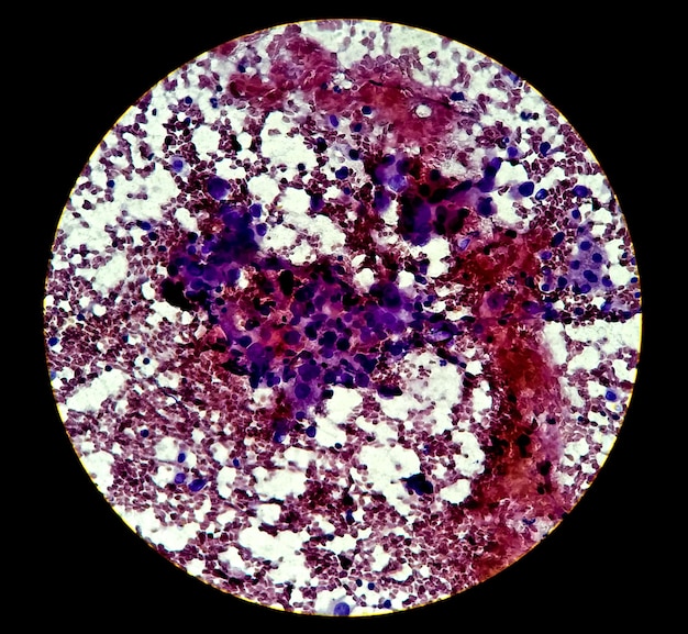 Photomicrograph showing adenocarcinoma of gallbladder. Gallbladder cancer. FNAC test, histology lab