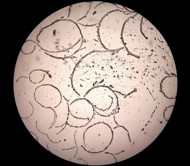 Photomicrograph of skin scraping for fungus test showing dermatophytes.