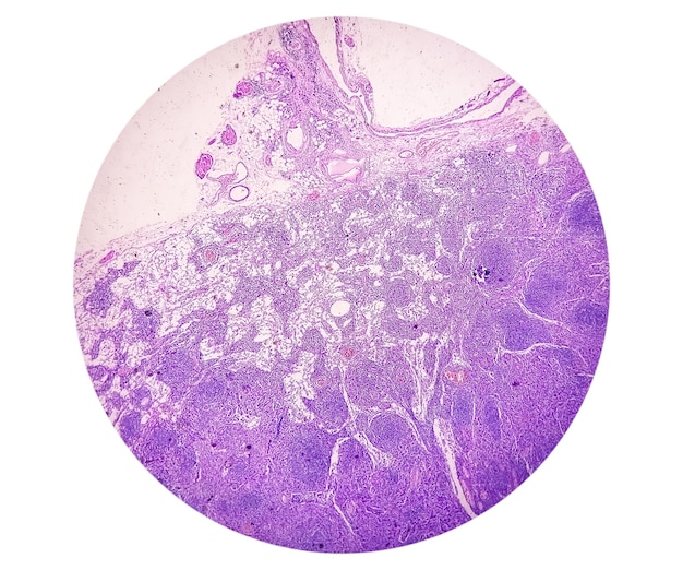 Photomicrograph of Stomach Adenocarcinoma. Gastric Adenocarcinoma.