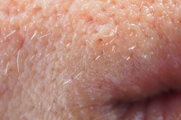 Pimple and acne on face skin and mouth, zoom macro. Oily pore skin.  