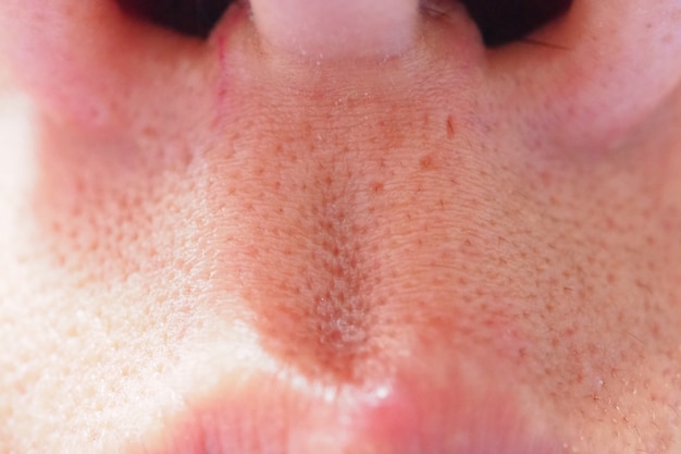 Pimple and acne on face skin and nose, zoom macro. Oily pore skin.