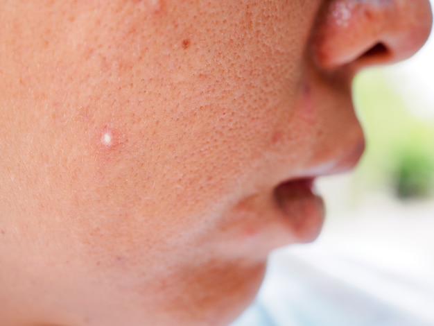 Pimple and acne on face skin, zoom macro.