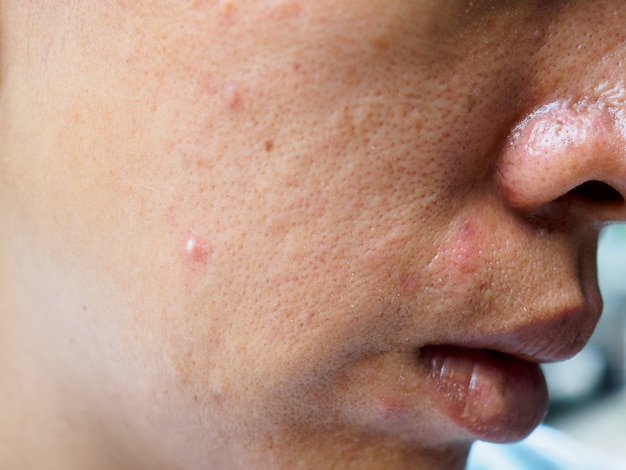 Pimple and acne on face skin, zoom macro.