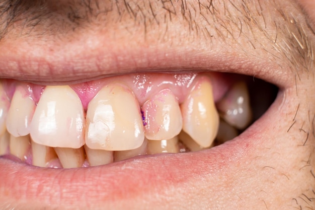 Plaque on human teeth is colored pink with indicator tablets