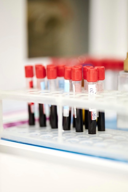 Plastic test tubes with blood samples stand on a stand in a hospital. Medical equipment.