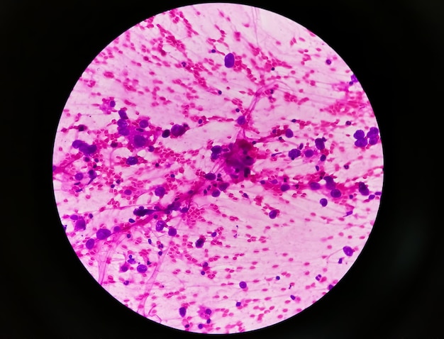 Photo pleural fluid fnac showing photomicrograph of metastatic adenocarcinoma of lung