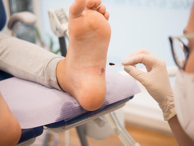 Podiatrist treating a verruca on a patient39s foot