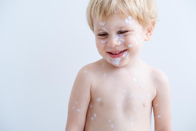 portrait of blonde little boy with red rashes Chicken pox virus, varicella with medical cream