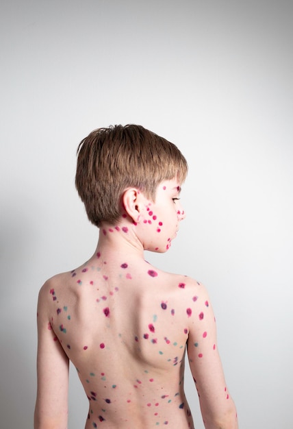 Portrait of an emotional little boy with chicken pox on the background of a gray wall