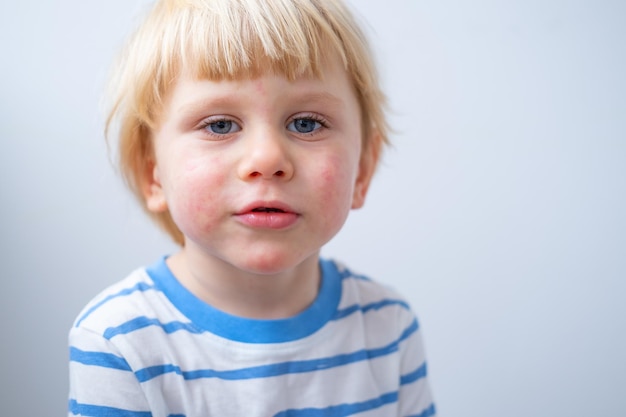 portrait of little boy with allergic rash or eczema on face severe allergic reaction atopic skin