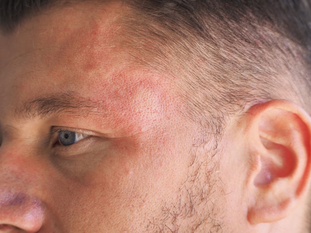 Portrait of a man with stung wasp in the head