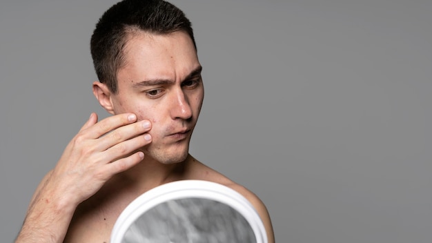 Portrait of young man with acne and copy space