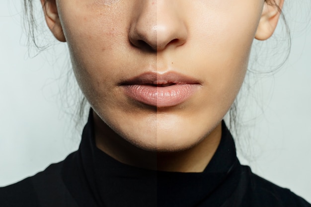 Portrait of young woman before and after cosmetic operation