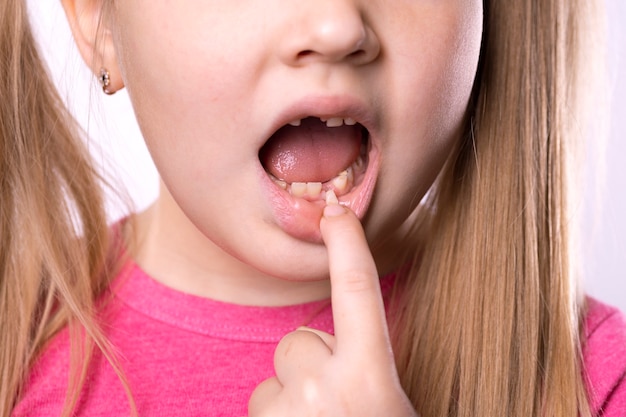 A preschool girl shows a lost tooth. The milk tooth has fallen out, and a permanent tooth grows in the open mouth. Dental hygiene concept.