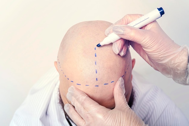 Process of hair transplantation on the head treatment of baldness a nurse draws stripes on the bald skull of a young man for brain surgery The concept of surgery and medicine