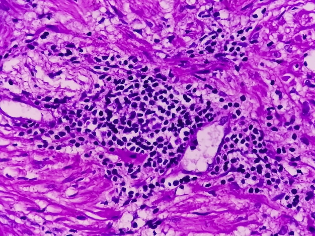 Prostate Cancer or adenocarcinoma or malignant neoplasm or atypical epithelial cells by TURP