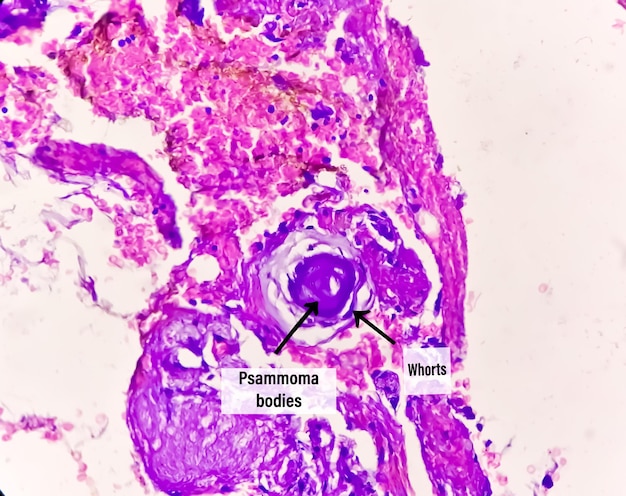 Psammoma bodies. Spinal tumor biopsy. Psammomatous meningioma.