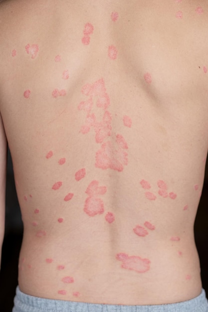 Psoriasis vulgaris skin patches are typically red itchy and scaly