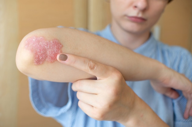 Psoriasis of a women on her elbows sitting on the bedroom floor Concept dermatology