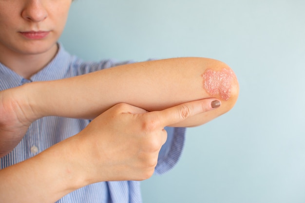 Psoriasis of a women on her elbows sitting on the bedroom floor Concept dermatology