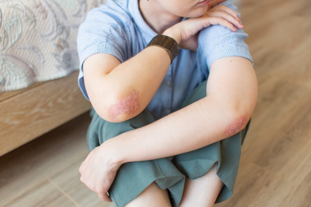 Psoriasis of a young girl on her elbows sitting on the bedroom floor Concept dermatology